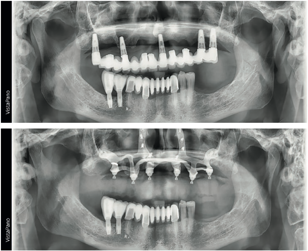 Rehabilitación de atrofias maxilares severas mediante implantes subperiósticos personalizados