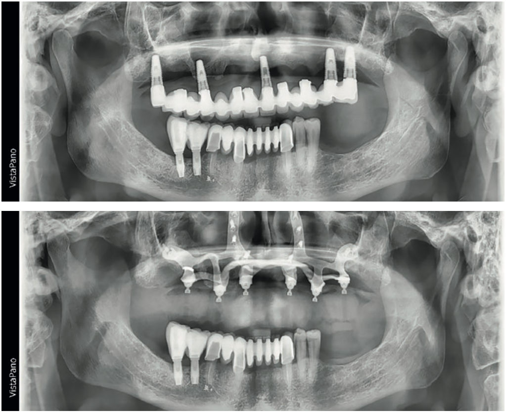 Rehabilitación de atrofias maxilares severas mediante implantes subperiósticos personalizados