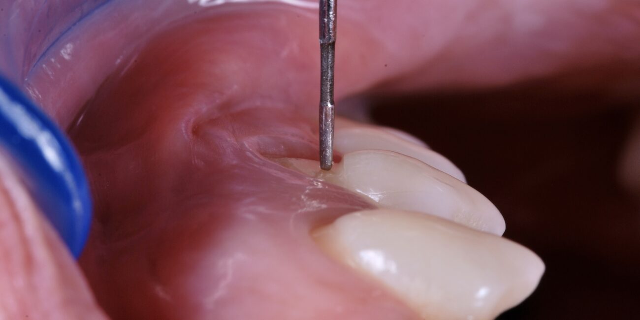 Práctica del curso cirugía mucogingival