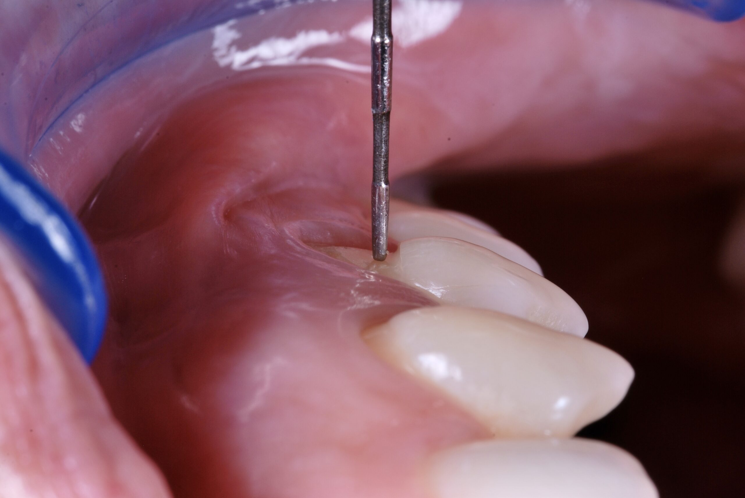 Práctica del curso cirugía mucogingival