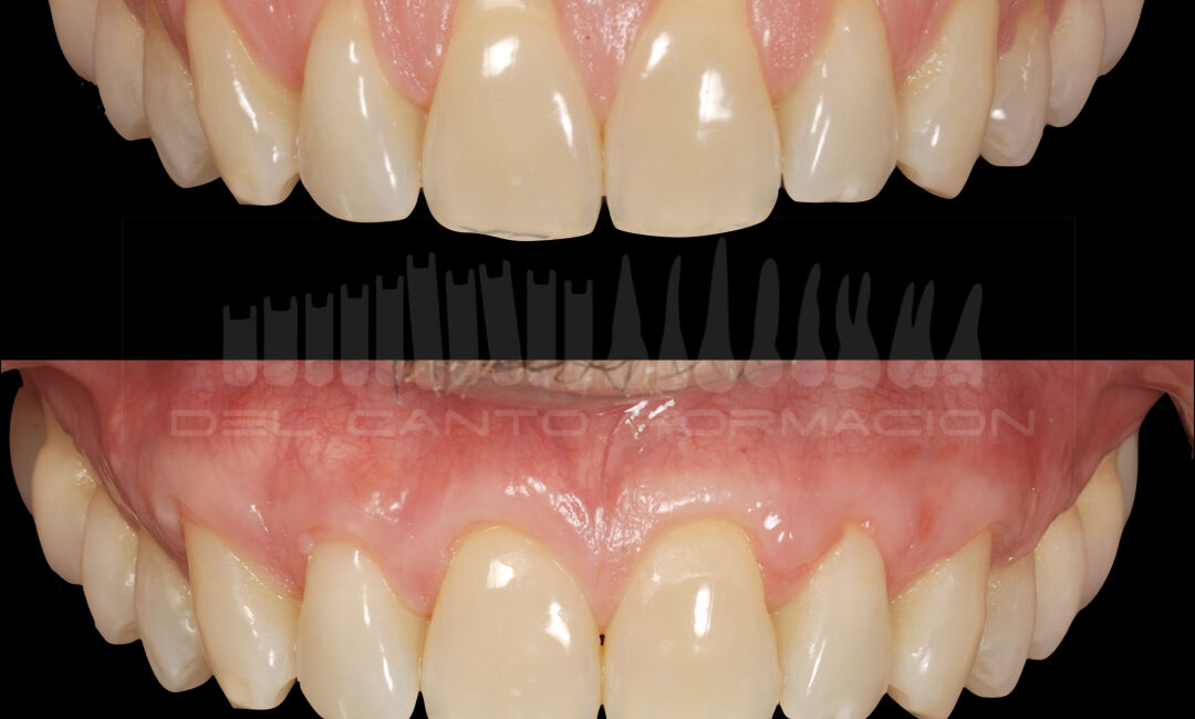 Gingivitis