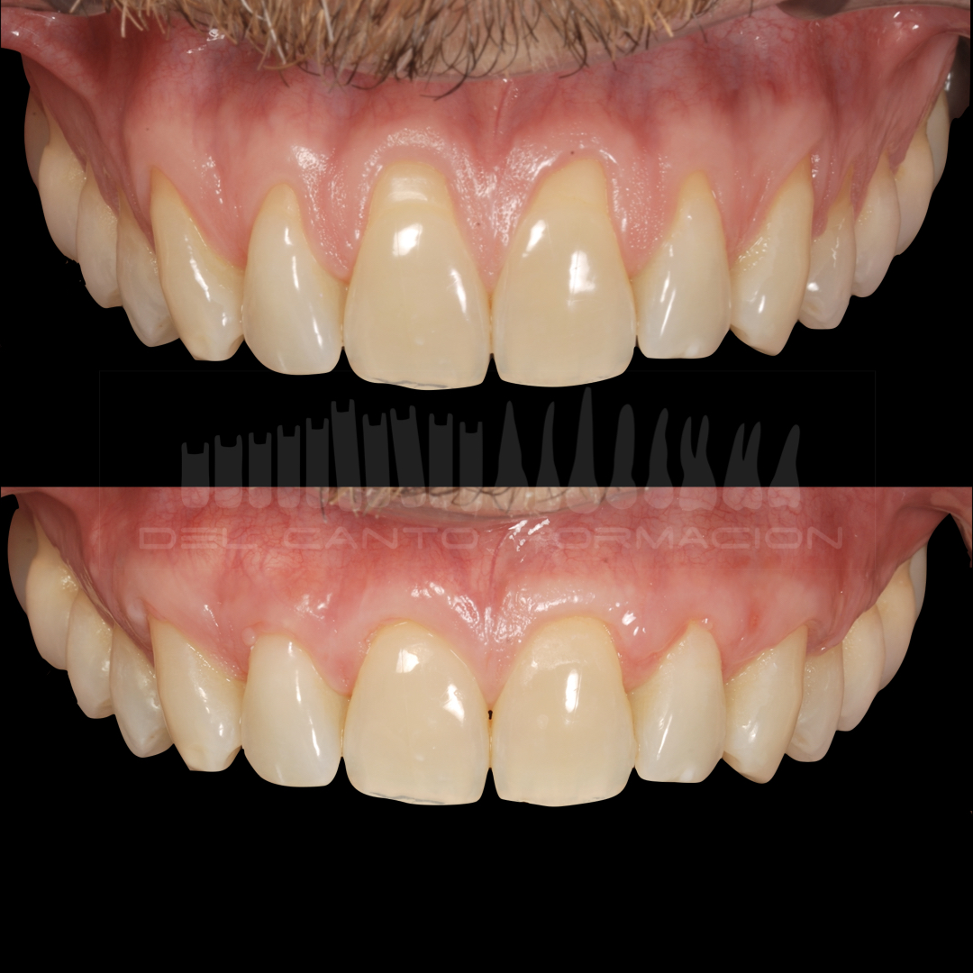 Gingivitis