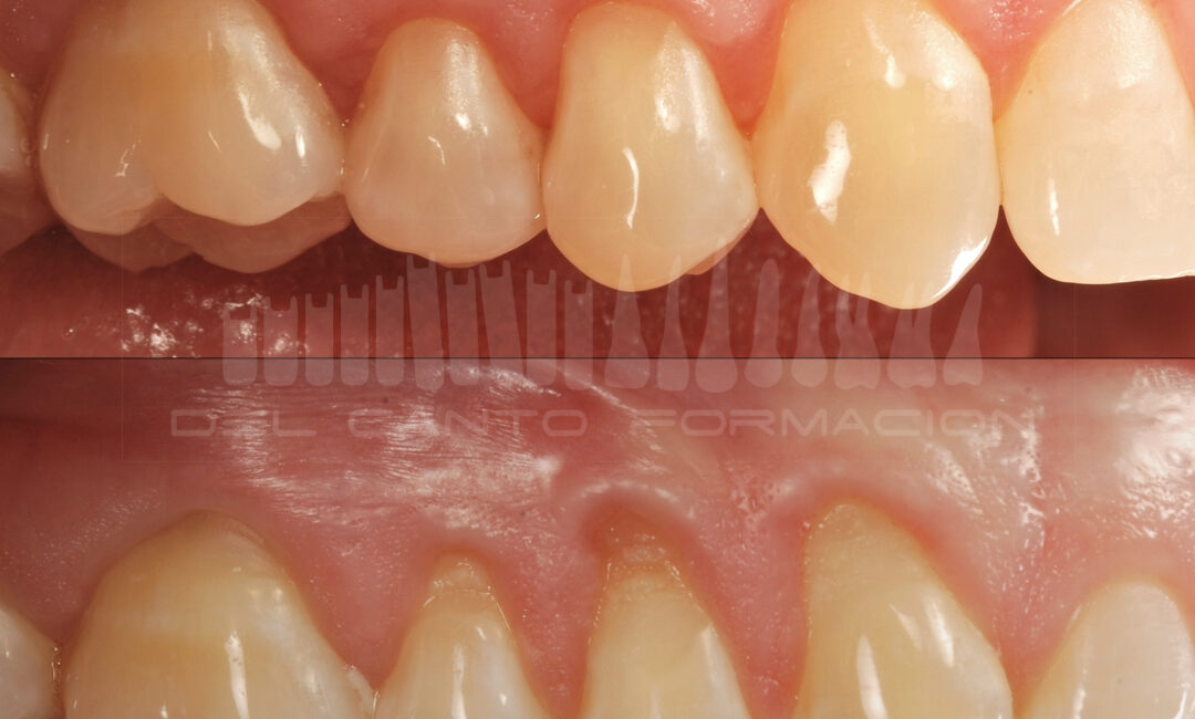 Gingivitis
