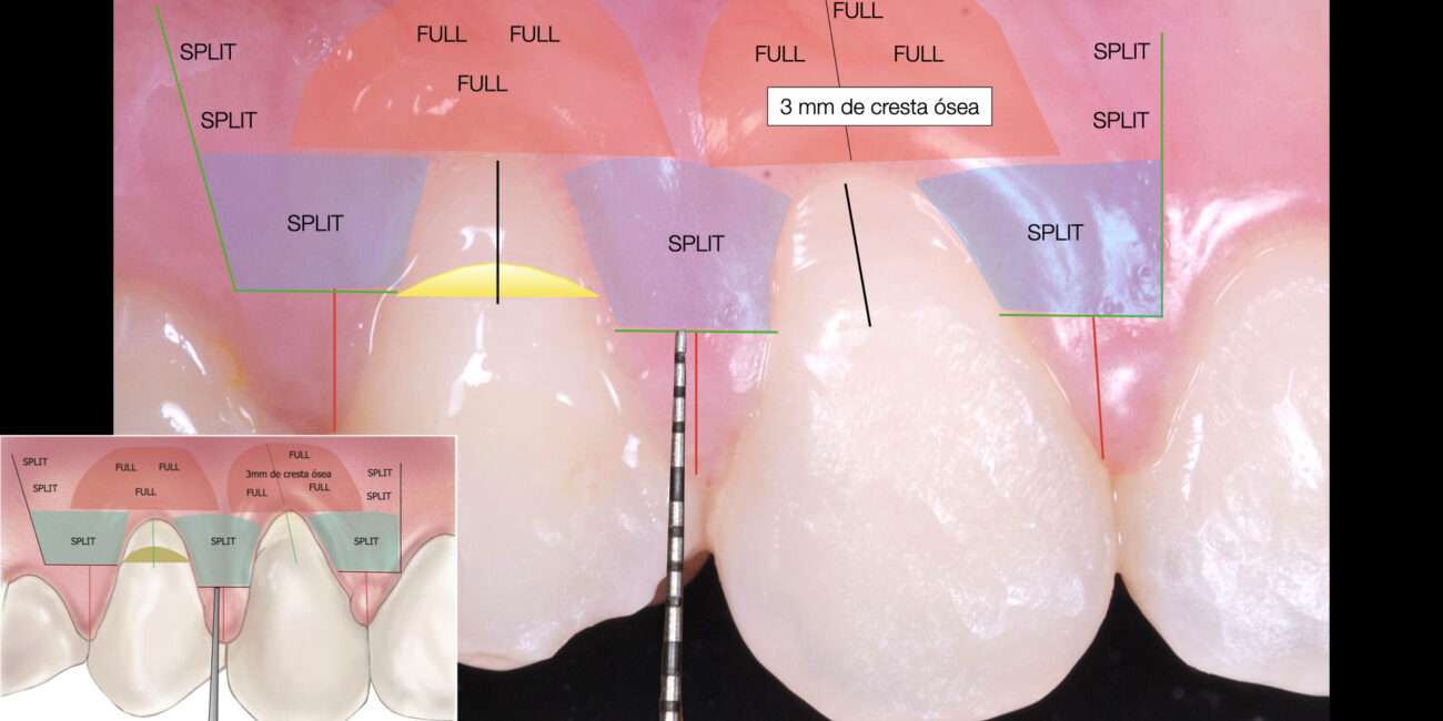 Taller mucogingival.