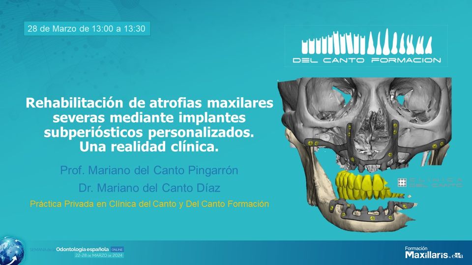 Rehabilitación de atrofias maxilares severas mediante implantes subperiósticos personalizados. Práctica Privada en Clínica del Canto y Del Canto Formación